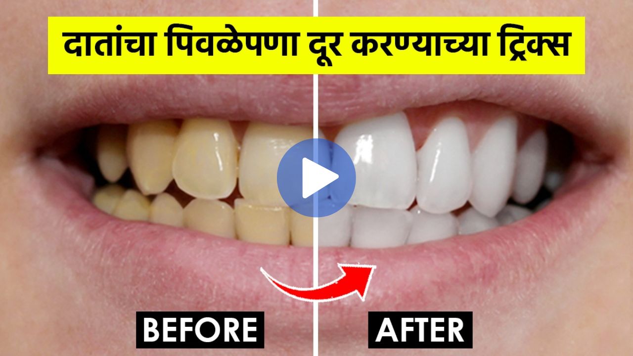 Home Remedies Teeth